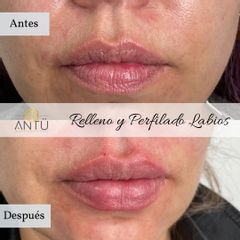 Aumento de labios - Clínica Antü