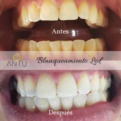Blanqueamiento dental - Clínica Antü
