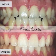 Ortodoncia - Clínica Antü