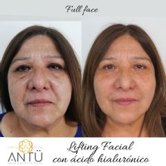 Rejuvenecimiento facial - Clínica Antü