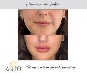 Aumento de labios - Clínica Antü