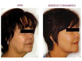 Rejuvenecimiento facial