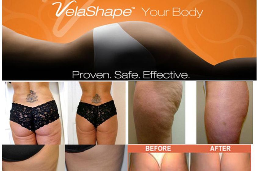 Tratamiento celulitis antes y después - 499249