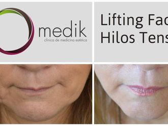 Hilos tensores - 539869