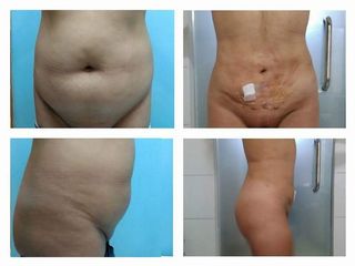 Lipotransferencia