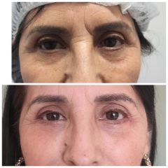 Blefaroplastia - Dr. Álvaro Sánchez