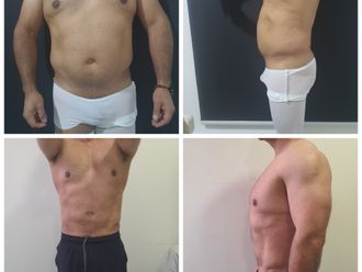 Abdominoplastía antes y después - 866941