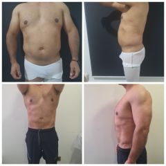 Abdominoplastia - Dr. Álvaro Sánchez