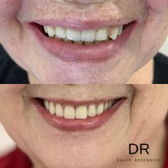 Implantes dentales - Dr. David Rosenberg Messina