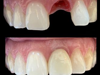 Implantes dentales-801675