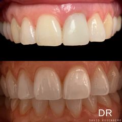 Implantes dentales - Dr. David Rosenberg Messina