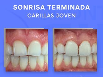 Carillas dentales - 854329