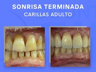 Carillas dentales - 854330