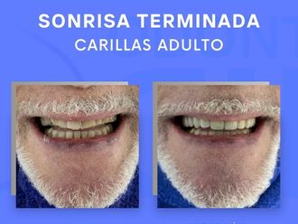 Carillas dentales - 854331
