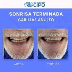 Carillas dentales - Dr. David Rosenberg Messina