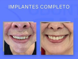 Implantes dentales - 854332