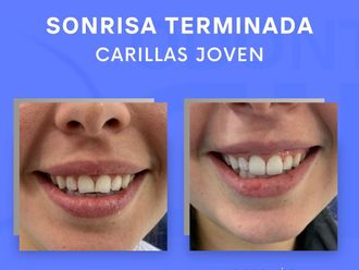 Carillas dentales - 854333
