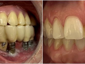 Implantes dentales - 854892