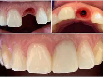Implantes dentales - 854893