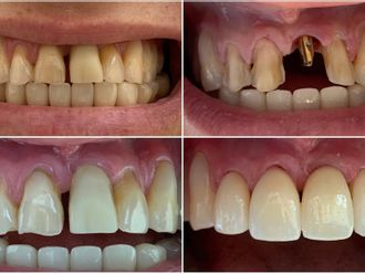 Implantes dentales - 854894