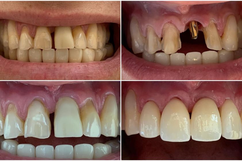 Implantes dentales antes y después - 854894