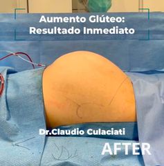 Aumento glúteo con Implante - resultado inmediato. Dr Claudio Culaciati Cirujano Plástico Acreditado