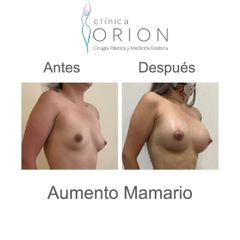 Aumento Mamario - Clínica Orion