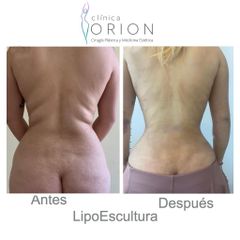 Lipoescultura - Clínica Orion