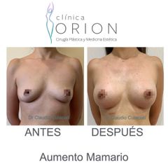 Aumento Mamario - Clínica Orion