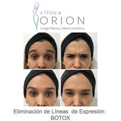 Botox - Clínica Orion