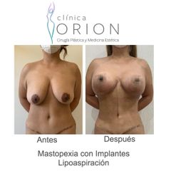 Lipoaspiración y Mastopexia con Implantes - Clínica Orion