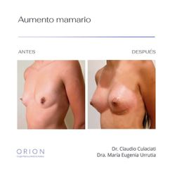 Aumento Mamario - Clínica Orion