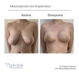 Mastopexia sin implantes - Clínica Orion