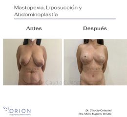 Cx Triple: Mastopexia + Lipoaspiración+ Abdominoplastía - Clínica Orion