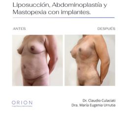 Abdominoplastía + Liposucción + Mastopexia - Clínica Orion