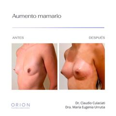 Aumento mamario - Clínica Orion