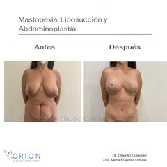 Lipoescultura - Clínica Orion
