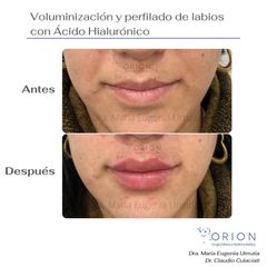 Aumento de labios - Clínica Orion