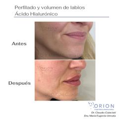 Aumento de labios - Clínica Orion