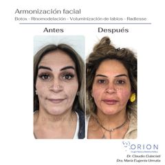 Armonización facial - Clínica Orion