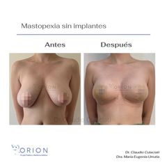 Mastopexia - Clínica Orion