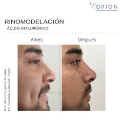Rinomodelación - Clínica Orion