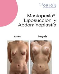 Aumento Mamario, Liposuccion, Abdominoplastía - Clínica Orion