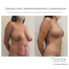 Lipoescultura - Clínica Orión