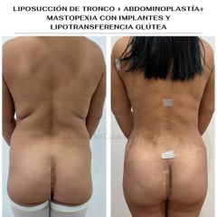 Liposucción - Clínica Orión