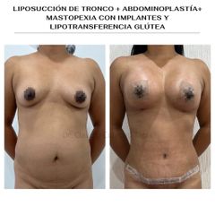Abdominoplastia - Clínica Orión