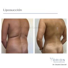 Liposucción - Clínica Orión