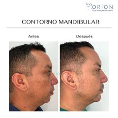 Contorno mandibular - Clínica Orión