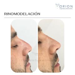 Rinomodelación - Clínica Orión