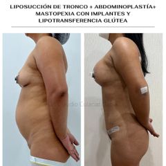 Liposucción - Clínica Orión